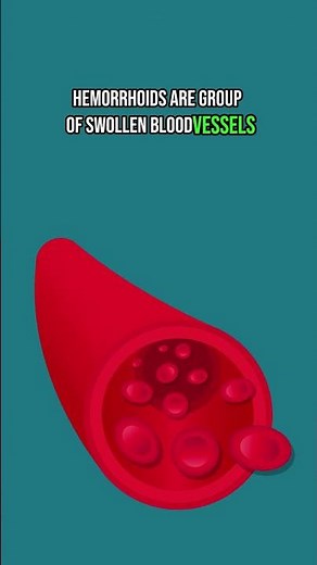 Hemorrhoids and Blood in Stool