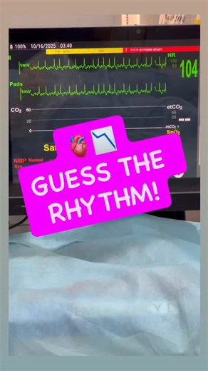 Moayad Wishah on Instagram: "🫀📉 GUESS THE RHYTHM! Think you know what this ECG shows? 🤔 Drop your answer below 👇🔥 🔎✨ Clue: ❤️➡️⚡➡️📊 #GuessTheRhythm #ECGChallenge #RhythmQuiz #EKGFun #NursingEducation #EmergencyNursing #CardiologyEducation #MedEd #NurseLife #HealthcareLearning #ECGPractice #EKGStrip #ClinicalSkills #SimLab"
