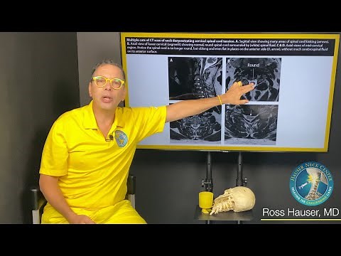 Spinal cord tension and cervical dysstructure: MRI, CT, and symptom discussion with Ross Hauser, MD