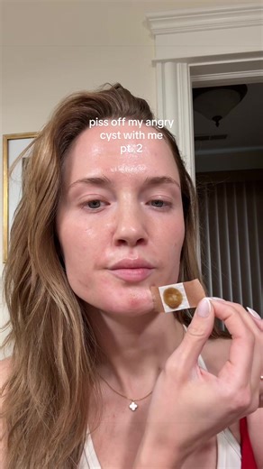 Replying to @Anjalie Asencio I have no words…. #cysticacne #pimplepopping #cysts #acneproblems #acnetreatment