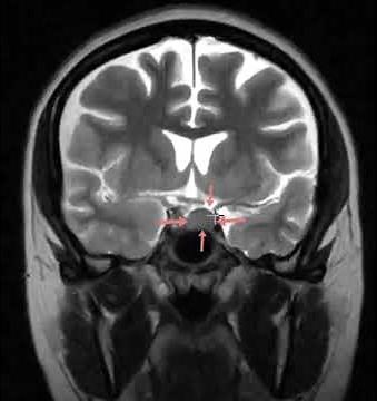 Pituitary Adenoma causing left visual disturbance