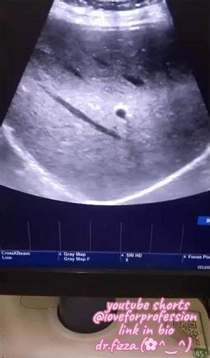 Understanding Abdominal Scans: A Guide for Students