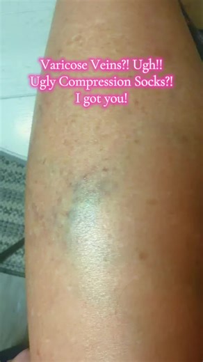 Alivio para Venas Varicosas con Calcetines de Compresión