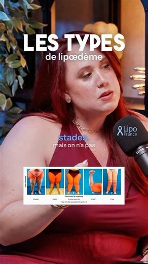 LipoFrance | Association Française de lutte contre le lipœdème on Instagram: "Dans ce 5ème épisode du podcast LipoFrance, on va évoquer en détails les STADES et les TYPES du lipœdème. Est abordé également l’évolution de la maladie, les zones touchées et le lien avec l’alimentation, les régimes, l’obésité, etc. Ici, vous pourrez reconnaître (les types peuvent être nuancées au cas par cas) les différents TYPES de la maladie, et ainsi vous permettre de vous reconnaître en tant que malade. 📽️ Cet e