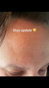 😱 You won't believe what came out of this one... #pimplepop #satisfying | Pimple Popping