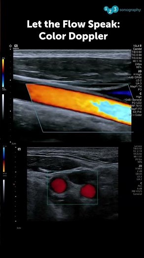 Let the Flow Speak: Color Doppler 🌈