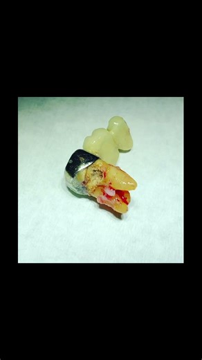 Grossly decayed tooth bridge #implantdentistry #allon6 #fullarchimplants #dentistry