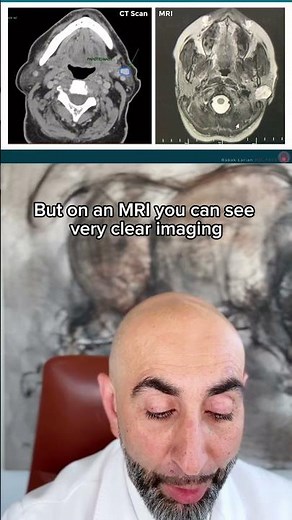 CT scan vs. MRI for parotid tumors #parotidtumor #parotidgland #parotid