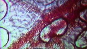 FDA approves colon cancer blood test known as "Shield"