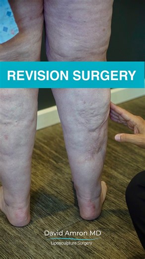 🙋‍♀️My patient Stephanie had a liposuction procedure done with a previous surgeon. There was a complication on her right leg, which created a significant gaping wound and the skin scarred down into muscle. This likely occurred from vascular compromise and the surgeon not staying in the “safe plane,” entering into deeper structures unknowingly with the cannula. Then the skin quickly became ischemic. There were also irregular areas throughout her legs because the prior treatment did not respect t