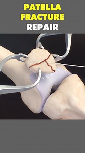 Patella Fracture Repair 3D Animation (Arthrex Mesh) #patellafractures #patellafracture #patellafracturerecovery #patellafracturesurgery #fracturerepair #bonefracturerepair #arthrexmesh #medical3danimation #3dmedicalanimation | Mix Dancing Events