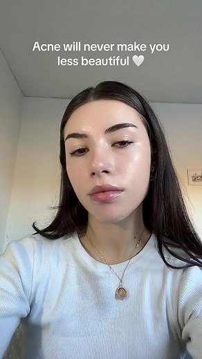 Embracing Beauty: Pretty Girls with Acne