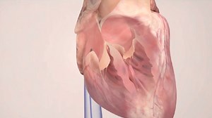 Doc Talk: Complex ablations on heart patients