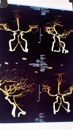 Neuro Anaesthesia: Where Silence Saves the Brain 🧠