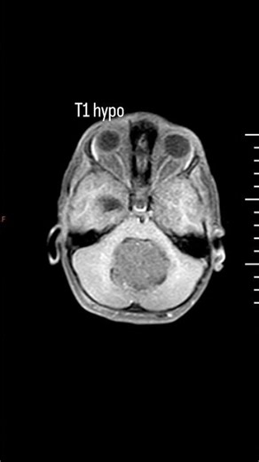 Midline medulloblastoma #radiology #neuroradiology