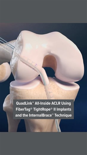 Arthrex Medical Education on Instagram: "This animation demonstrates the technique for QuadLink™ all-inside ACL reconstruction (ACLR) using FiberTag® TightRope® II implants, ACL RetroConstruction™ guides, and the FlipCutter® III drill.* Watch the full video at the link in our bio. #Arthrex #Innovation #MedicalEducation *The InternalBrace surgical technique is intended only to augment the primary repair/reconstruction by expanding the area of tissue approximation during the healing period and is 