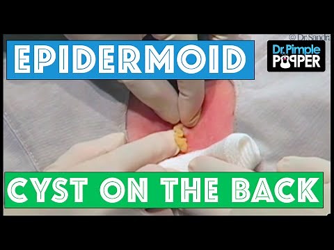 A Lucky Cyst Squeeze!