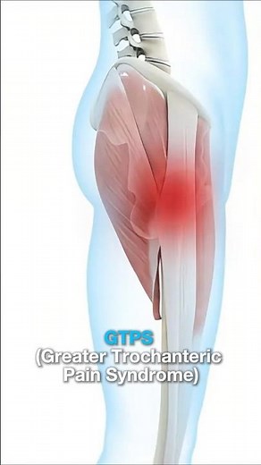 #1 What is GTPS (lateral hip pain)
