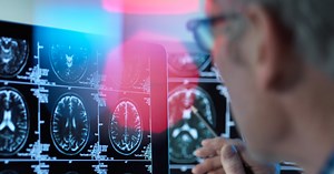 Data could hold the key to stopping Alzheimer's | Bill Gates