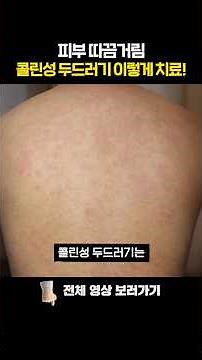 피부 따끔거림, 팽진, 콜린성 두드러기 이렇게 치료 됩니다