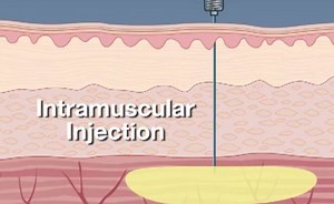Intramuscular Injection