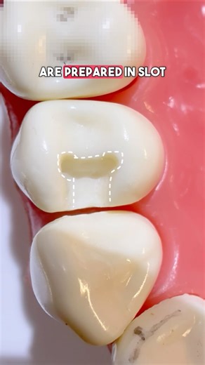 🦷 Retentive Groove in Slot cavity Preparation |Dr.Dentique-hub