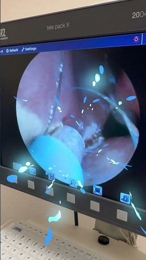 Stopping Nosebleeds with Cautery in the ENT Clinic - Shawn Allen MD - Sinus Specialist
