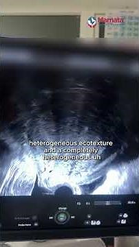 Severe Adenomyosis Classic Ultrasound Signs You Must Know! | Mamata Fertility Hospital: Hyderabad