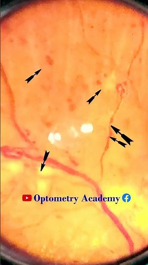 Diabetic retinopathy | Hemorrhages | cotton wool spots | Hard exudates | Fundus | Short Video 133