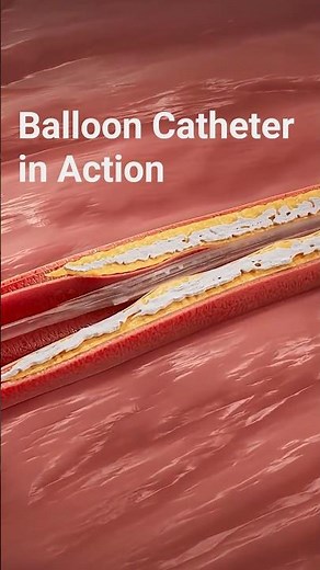 Serranator® Balloon Catheter in Action | PAD Treatment