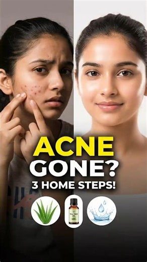 Acne Treatment at Home