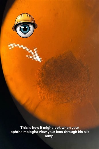 #cataract #eyes #ophthalmology #slitlamp #eyenimator