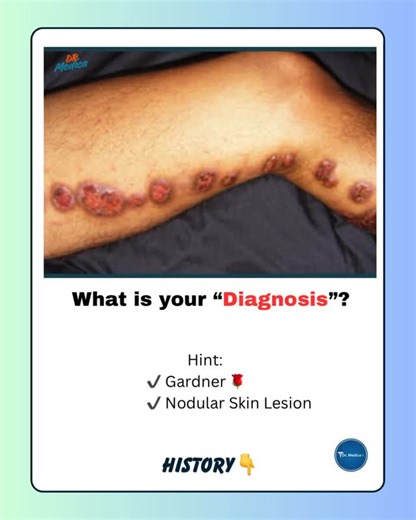 H.N.Ali (Dx & Tx)✨ on Instagram: "Dr Medica | Clinical Cases A gardener presents with nodular skin lesions on the leg that spread proximally along lymphatic channels. Most likely diagnosis? A) Cutaneous larva migrans B) Sporotrichosis C) Erysipelas D) Pyoderma gangrenosum #DrMedica #ClinicalCases #Dermatology #InfectiousDisease #Pakistan"
