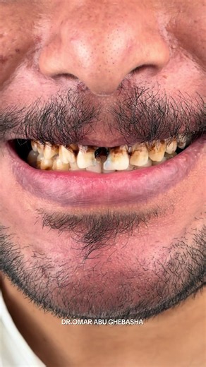 ‏2 RCT COMPOSITE VENEERS (VOICE OVER)