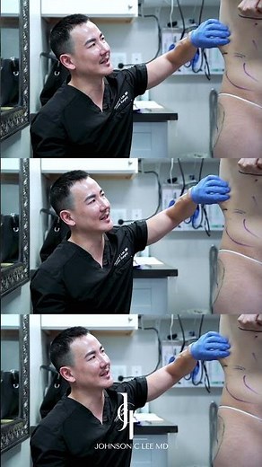 Transgender Feminization Surgery