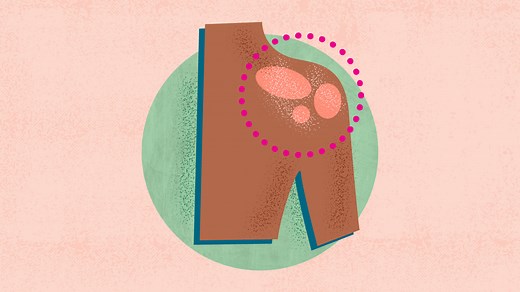 Psoriasis: Symptoms, Causes, Diagnosis, Treatment, and Prevention