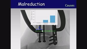The Ankle Syndesmosis: Diagnosis, Reduction and Fixation
