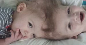 Conjoined twins recover after historic surgery