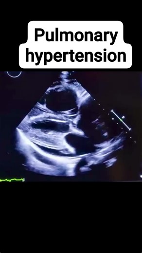 ‎د.جمال العزب‎ on Instagram: "Severe pulmonary hypertension involves elevated pressure within the pulmonary arteries do straining the right ventricle and potentially leading to right heart failure . Echo findings typically include right ventricular hypertrophy, right atrial enlargement, tricuspid regurgitation, pulmonary artery dilation, and flattening or paradoxical motion of the interventricular septum. These findings serve as important diagnostic markers, guiding treatment strategies and moni