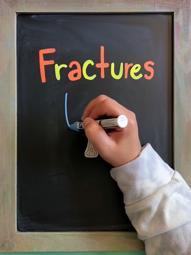 Understanding Different Types of Fractures in Nursing: A Comprehensive Guide