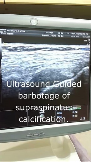 Ultrasound Guided Barbotage of Supraspinatous Calcification