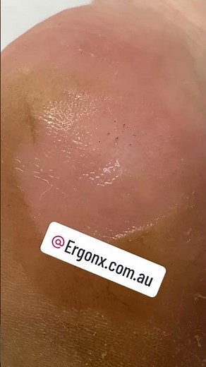 Incredible Split Heel Transformation with Australian Podiatrist #Podiatry #CallusRemoval