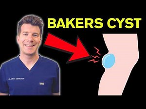 Doctor explains Bakers Cyst (Popliteal Cyst) | Causes, symptoms & treatment
