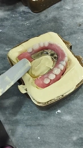 Upper jaw overdenture placement