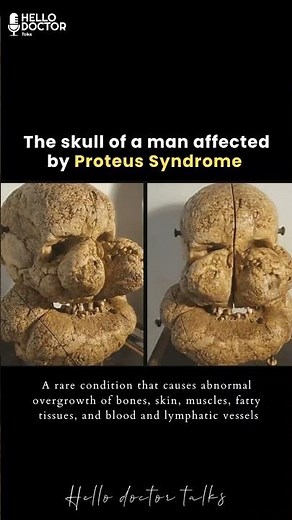 A rare condition that causes abnormal overgrowth of bones, skin, muscles, fatty tissues