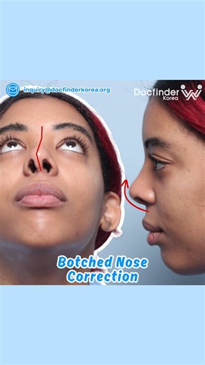 🗣️How I corrected my botched nose in Korea and got chin augmentation: “My nose was botched by previous rhinoplasty done in another country. It looked upturned and crooked, so I decided to contact Docfinderkorea for the best results. Now I am super happy with the result of both Revision Rhinoplasty and Genioplasty. My nose looks natural and straight, and chin augmentation made my face more balanced. I am happy!” You can check full video of her transformation on our channel in Youtube! FREE servi