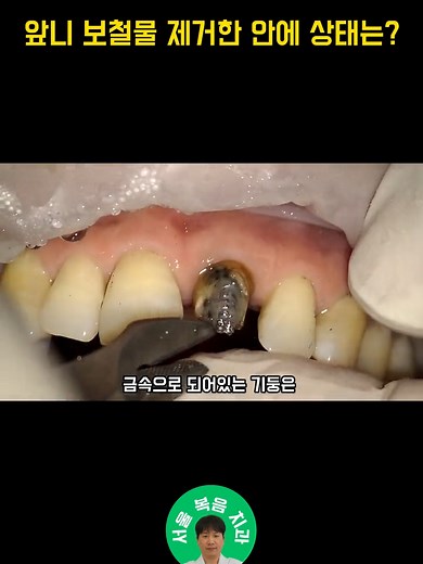 앞니 보철물 제거한 안에 상태는?? 과연!!! 잔존치아가 없을 시에는 기둥을 심어서 보강하기도 하는데요 대신 재 치료 할 때 기둥을 제거하는 과정에서 치아가 불러질 수도 안빠져서 발치를 해야하는 경우도 있습니다. 저희 서울복음치과에서는 치아가 어느정도 남아있어 안에 레진 보강재만 채운 후 보철물로 마무리 했습니다 #dentalclinic #dentalclinickorea #치과치료