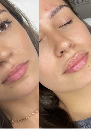 Lip Filler Techniques for Lasting Results