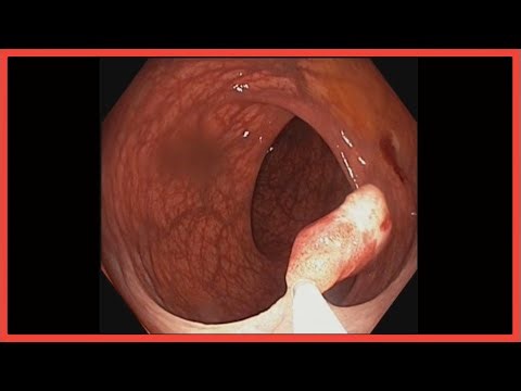 POLYPECTOMY Done !! POLYPECTOMY !! পলিপেকটমি করা হলো #BD_ENDOSCOPY