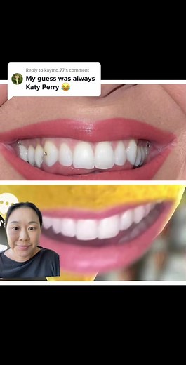 Katy Perry Veneers Transformation: Before and After Comparison